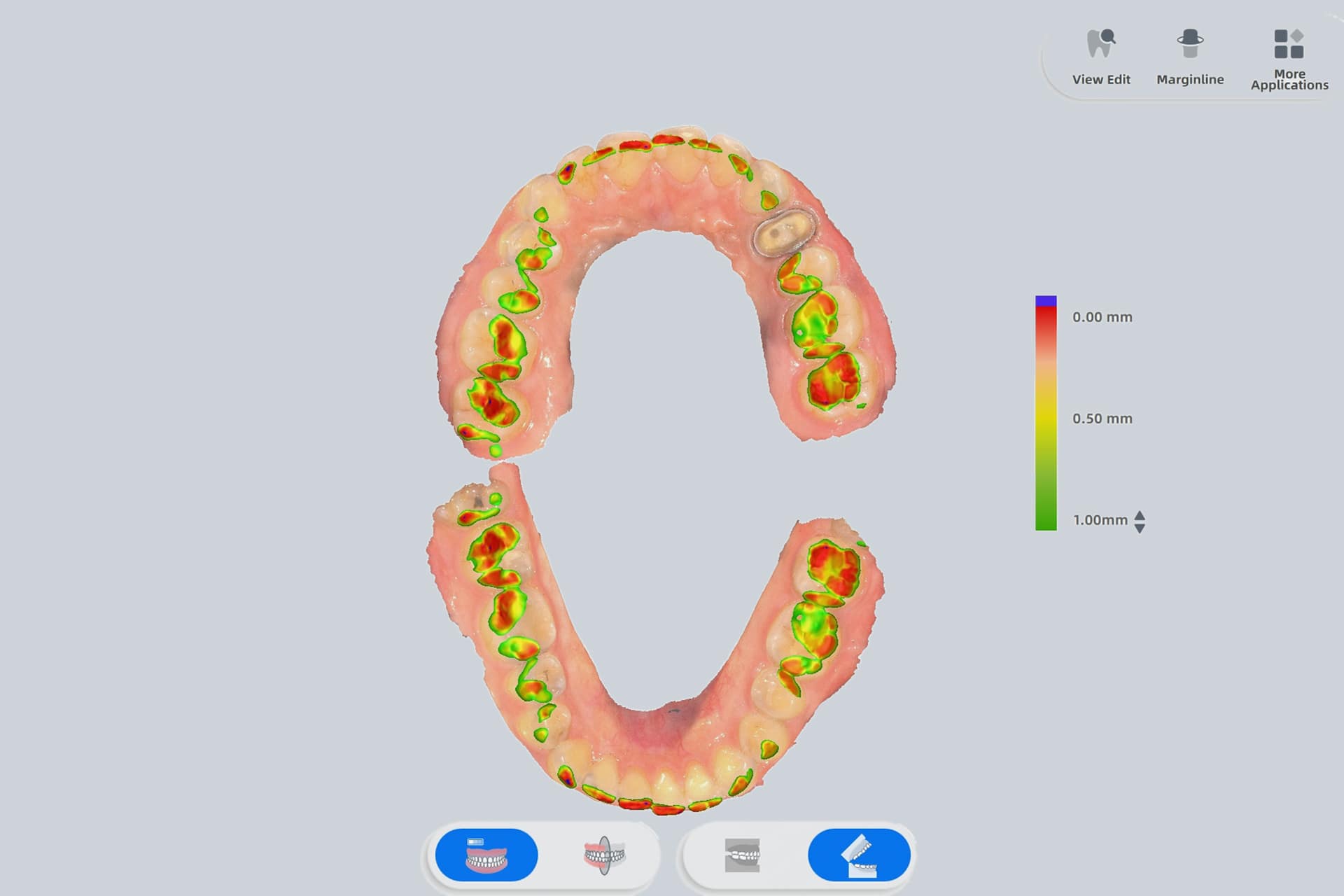 Empreinte dentaire 3D